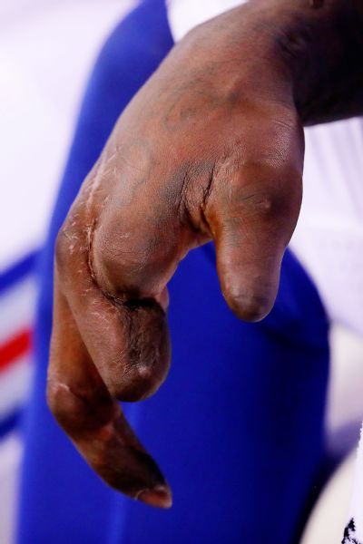 Pierre-Paul had his right index finger amputated after the accident. Despite wondering whether his Giants career was over, he managed to return for eight games in the 2015 season.