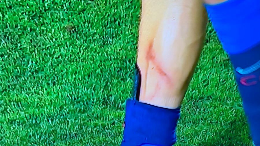 Álvaro Fidalgo showed his injury after Carioca’s harsh attack